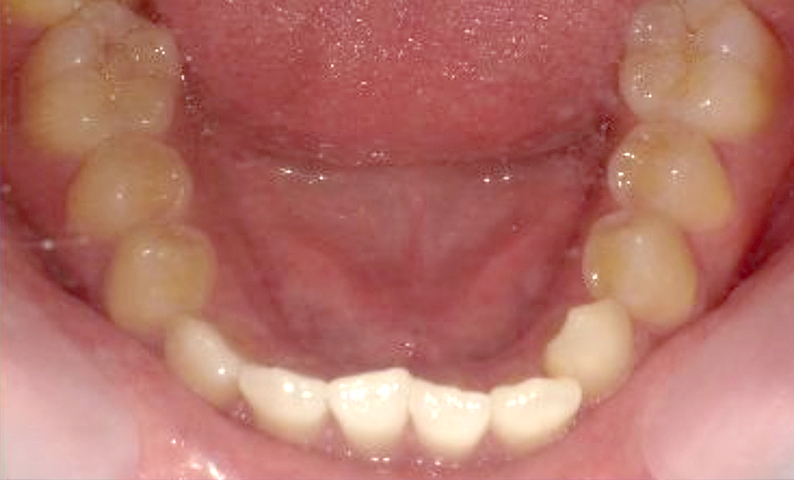 部分矯正 上下の部分矯正の症例写真