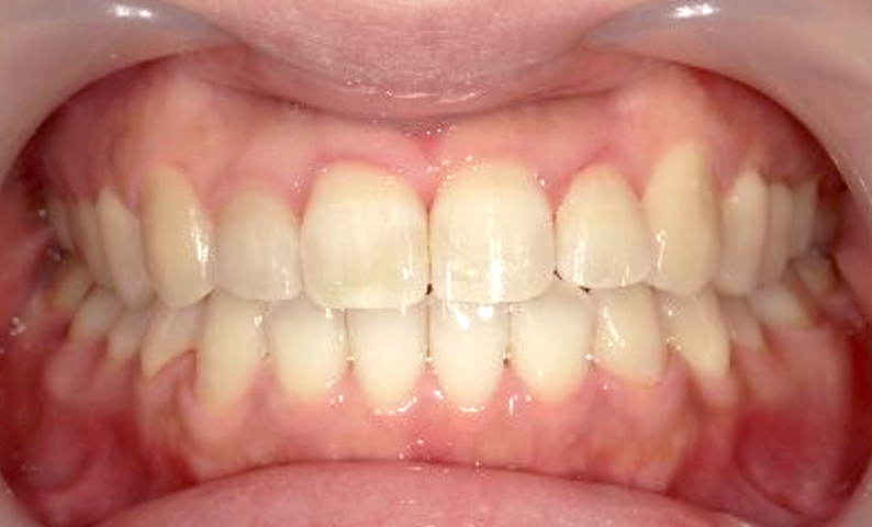 部分矯正 上下の部分矯正の症例写真