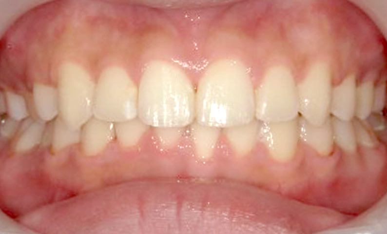 部分矯正 上下の部分矯正の症例写真