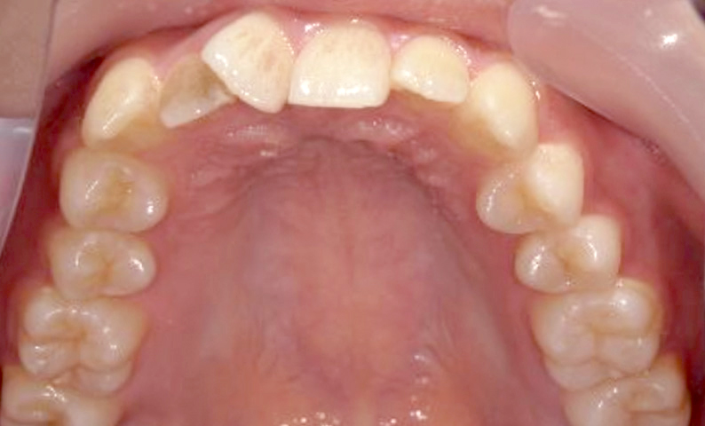 部分矯正 上下の部分矯正の症例写真