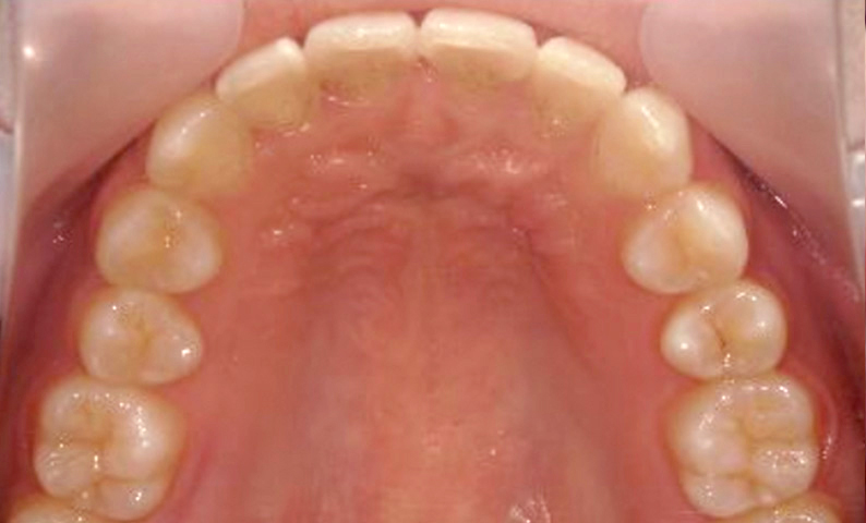 部分矯正 上下の部分矯正の症例写真