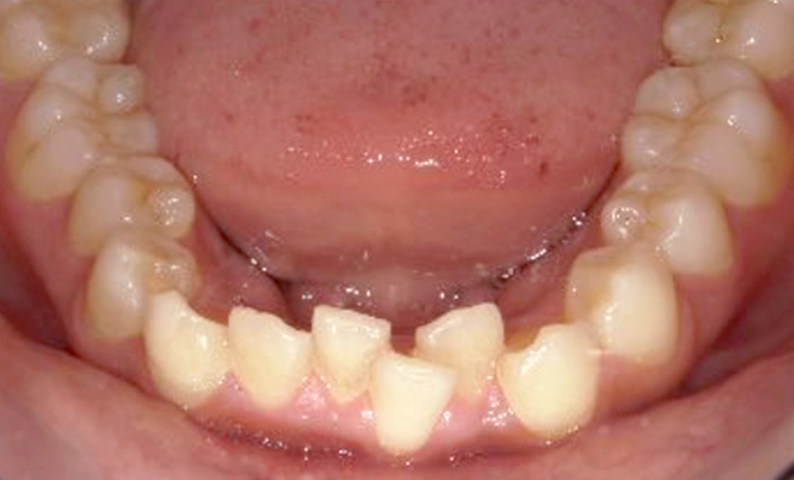 部分矯正 上下の部分矯正の症例写真