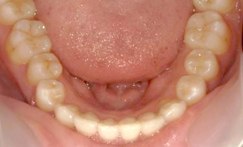 部分矯正 上下の部分矯正の症例写真