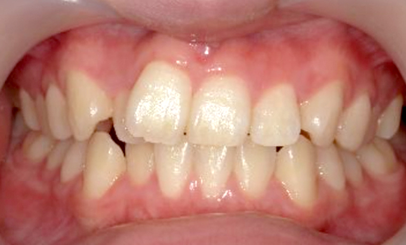 部分矯正 上下の部分矯正の症例写真