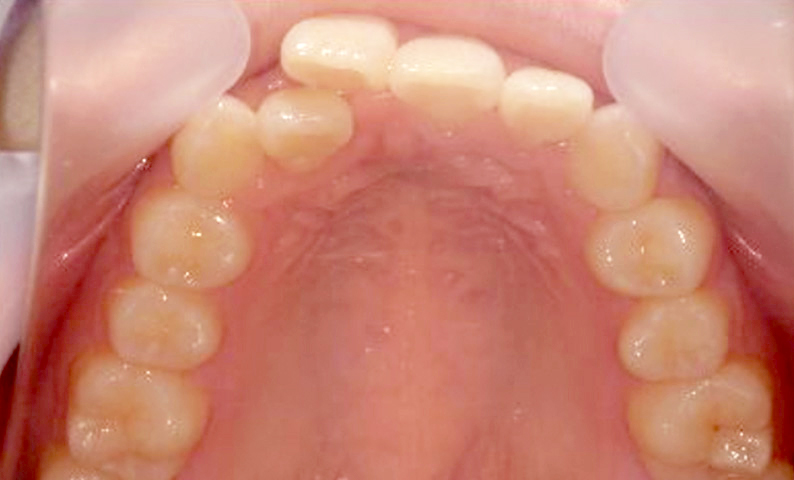 部分矯正 上下の部分矯正の症例写真