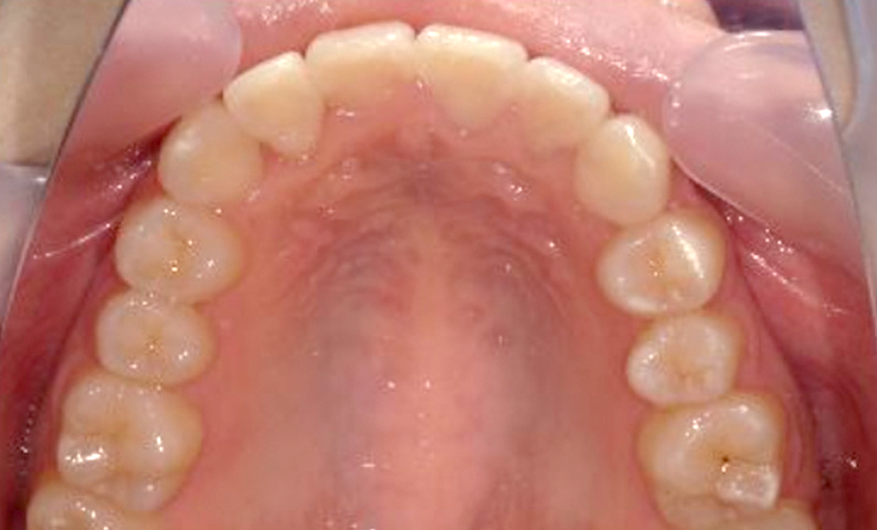 部分矯正 上下の部分矯正の症例写真