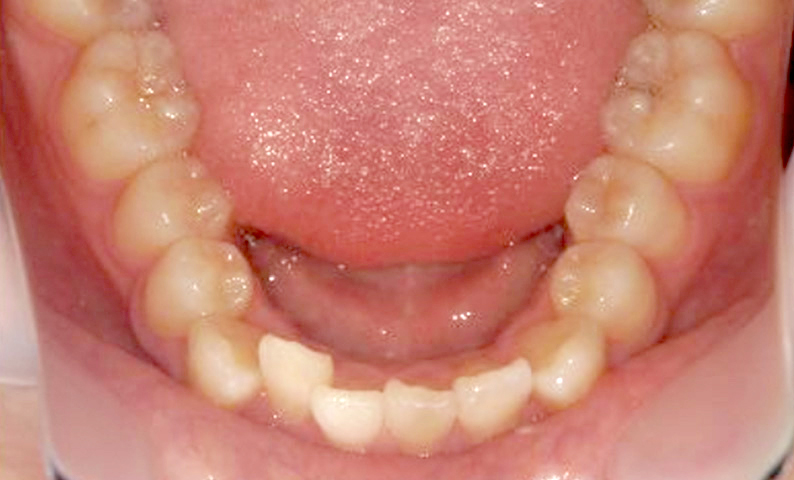 部分矯正 上下の部分矯正の症例写真