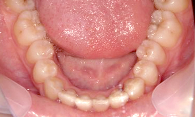 部分矯正 上下の部分矯正の症例写真