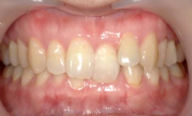 部分矯正 上下の部分矯正の症例写真