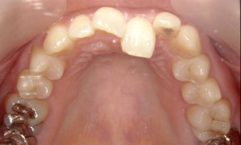 部分矯正 上下の部分矯正の症例写真