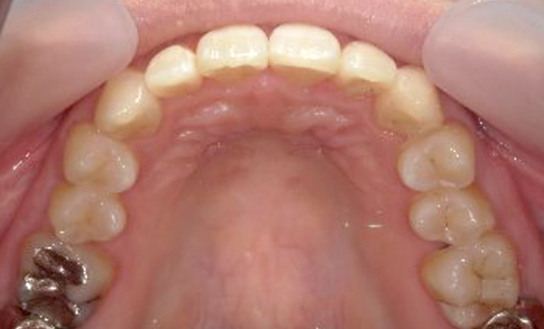 部分矯正 上下の部分矯正の症例写真