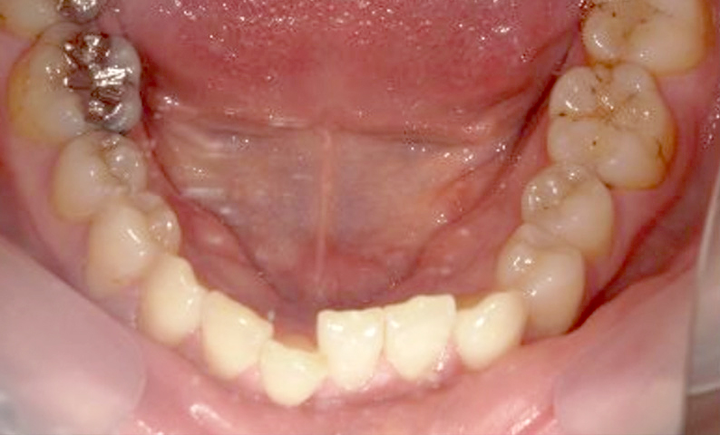 部分矯正 上下の部分矯正の症例写真