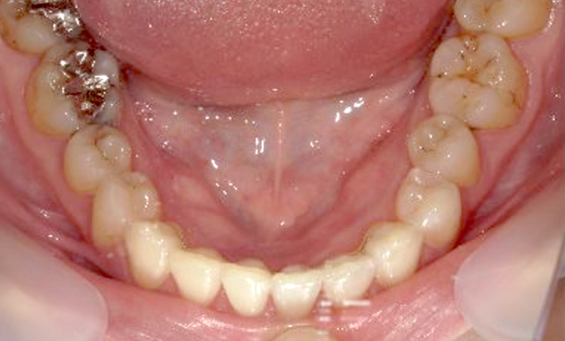 部分矯正 上下の部分矯正の症例写真