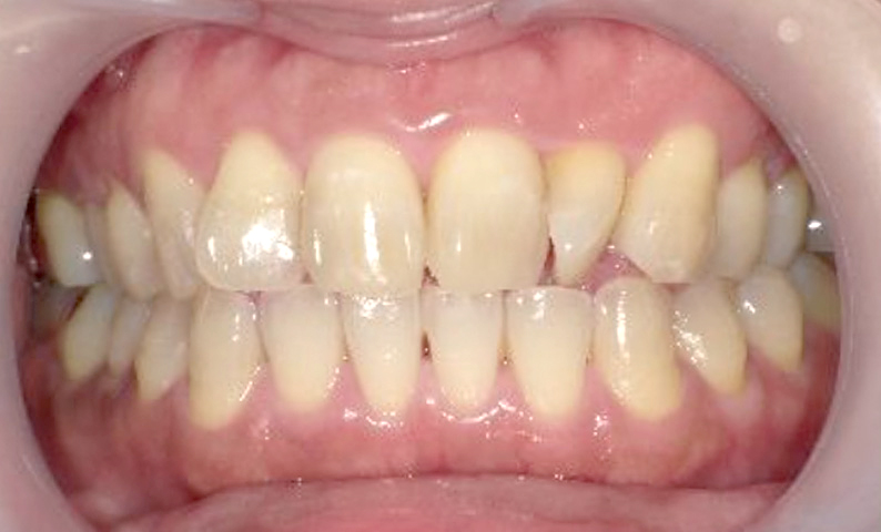 部分矯正 上下の部分矯正の症例写真