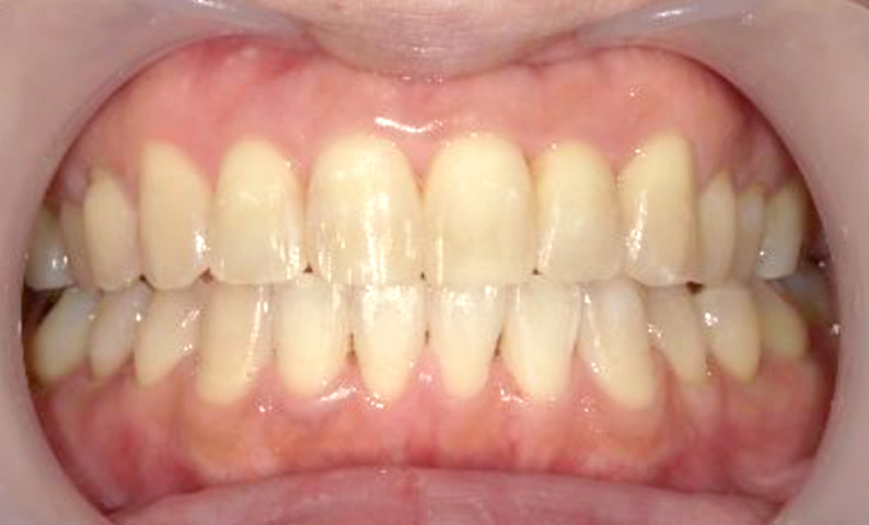 部分矯正 上下の部分矯正の症例写真