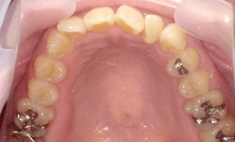 部分矯正 上下の部分矯正の症例写真