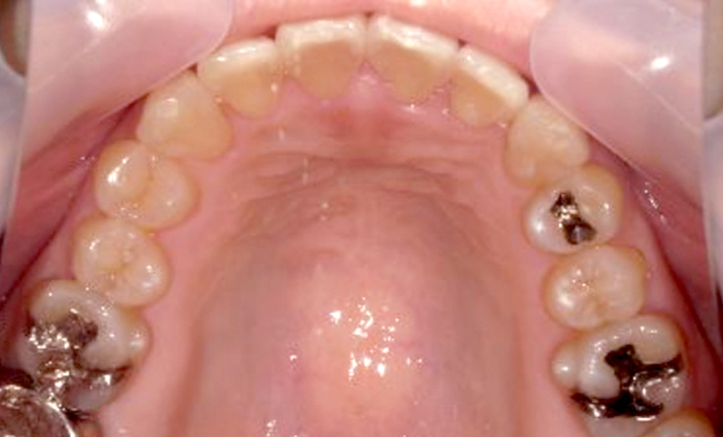 部分矯正 上下の部分矯正の症例写真