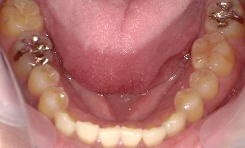 部分矯正 上下の部分矯正の症例写真