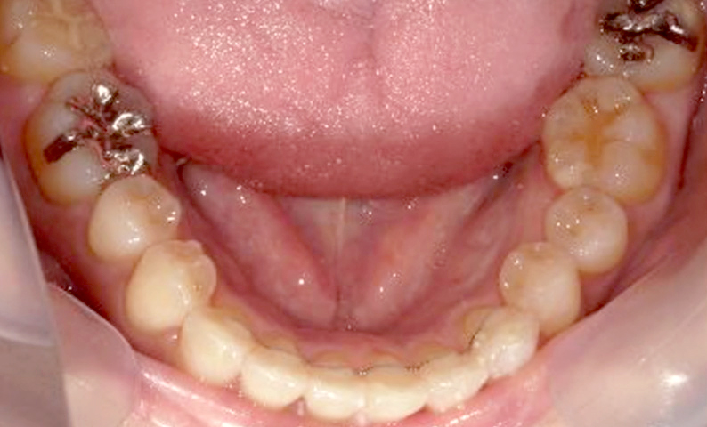 部分矯正 上下の部分矯正の症例写真