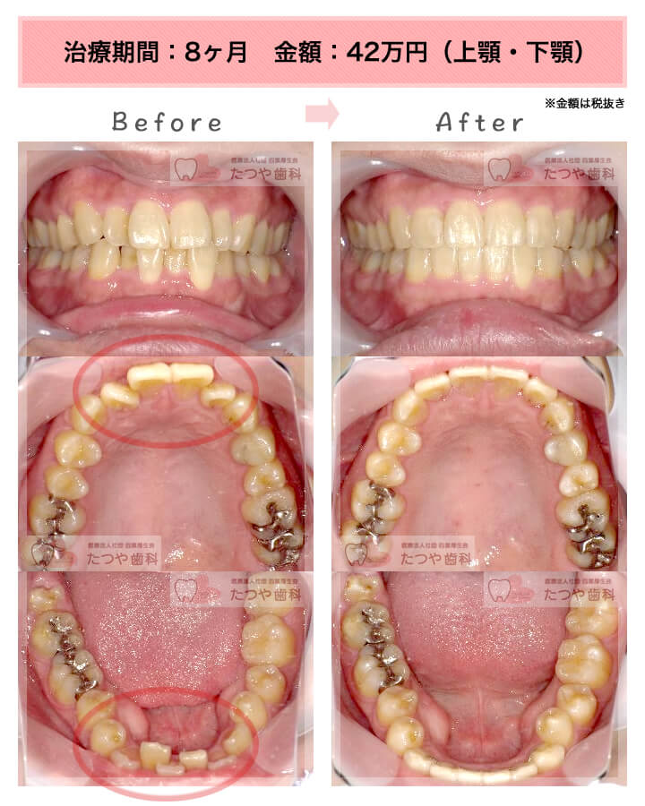 部分矯正の症例　上下の前歯
