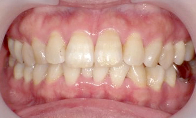 部分矯正 上下の部分矯正の症例写真