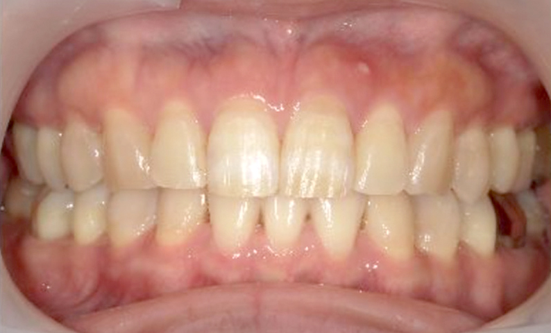 部分矯正 上下の部分矯正の症例写真