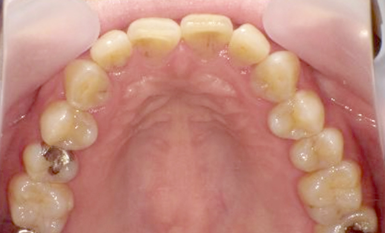 部分矯正 上下の部分矯正の症例写真