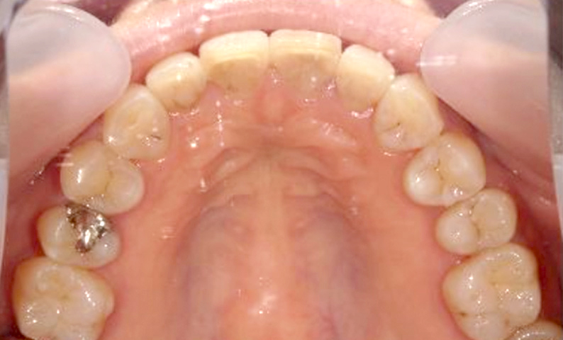 部分矯正 上下の部分矯正の症例写真