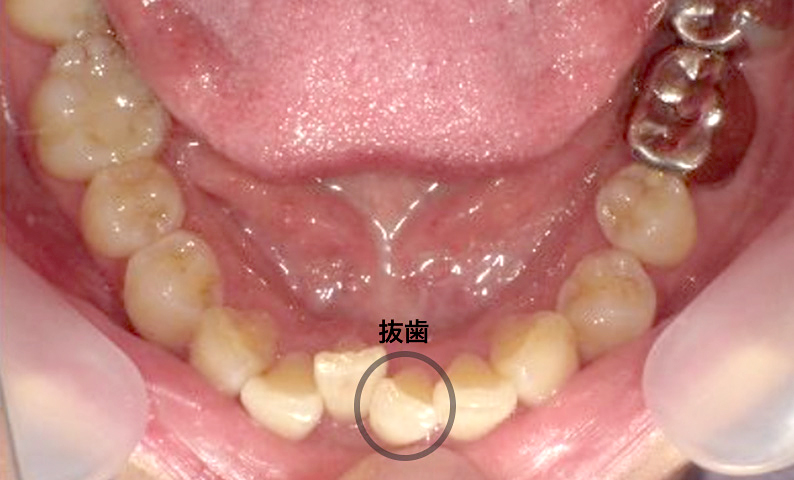部分矯正 上下の部分矯正の症例写真