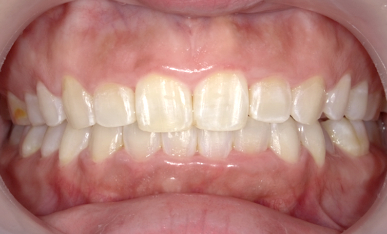 部分矯正 上下の部分矯正の症例写真