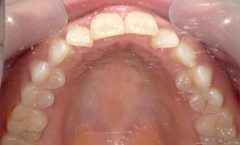 部分矯正 上下の部分矯正の症例写真