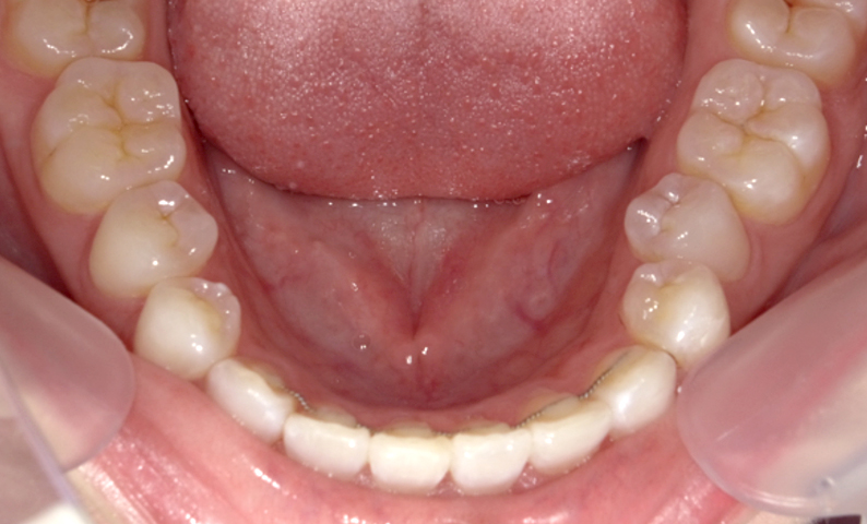 部分矯正 上下の部分矯正の症例写真
