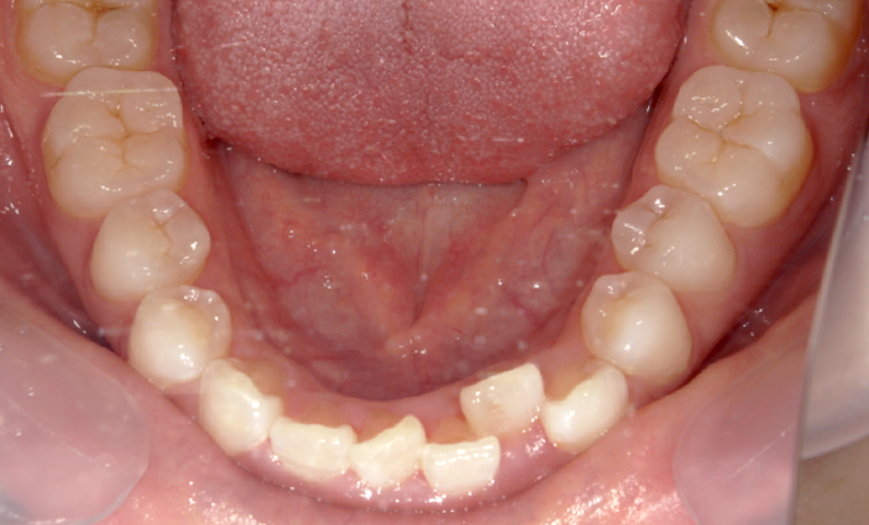 部分矯正 上下の部分矯正の症例写真