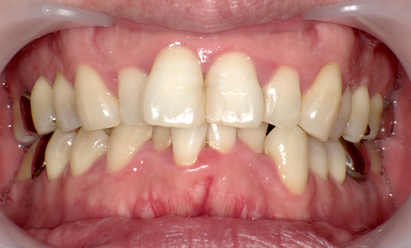 部分矯正 上下の部分矯正の症例写真