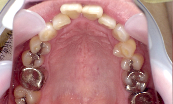 部分矯正 上下の部分矯正の症例写真