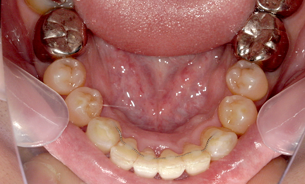 部分矯正 上下の部分矯正の症例写真