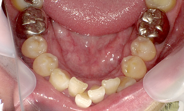 部分矯正 上下の部分矯正の症例写真