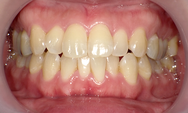 部分矯正 上下の部分矯正の症例写真