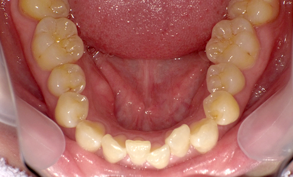 部分矯正 上下の部分矯正の症例写真