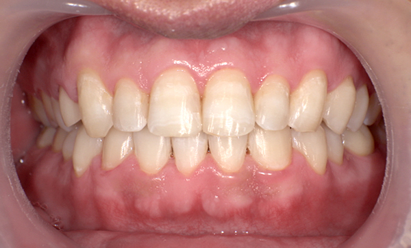 部分矯正 上下の部分矯正の症例写真