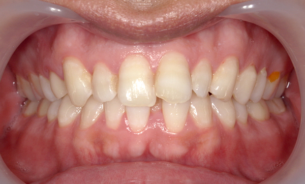 部分矯正 上下の部分矯正の症例写真