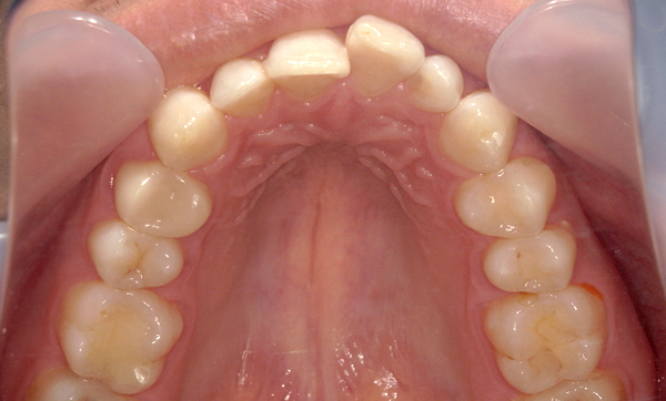 部分矯正 上下の部分矯正の症例写真