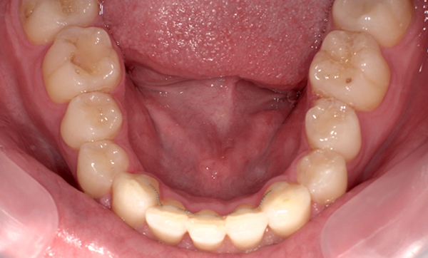 部分矯正 上下の部分矯正の症例写真