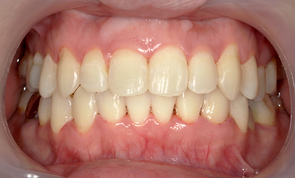 部分矯正 上下の部分矯正の症例写真