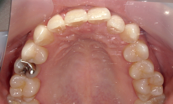 部分矯正 上下の部分矯正の症例写真