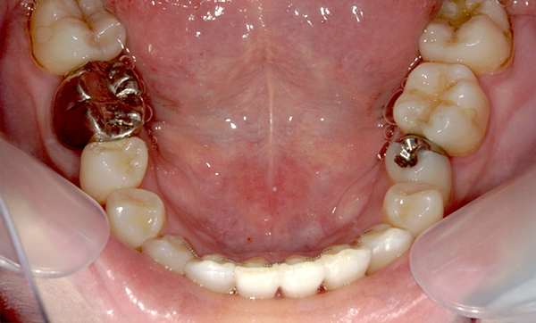 部分矯正 上下の部分矯正の症例写真