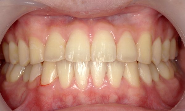 部分矯正 上下の部分矯正の症例写真