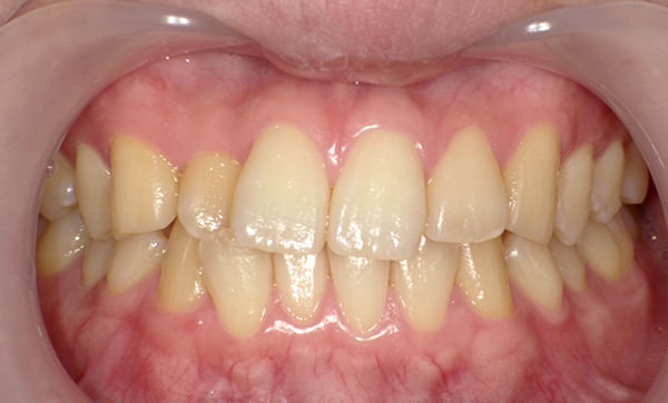 部分矯正 上下の部分矯正の症例写真