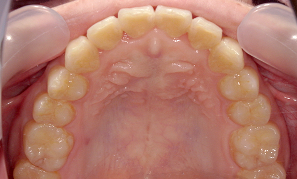 部分矯正 上下の部分矯正の症例写真