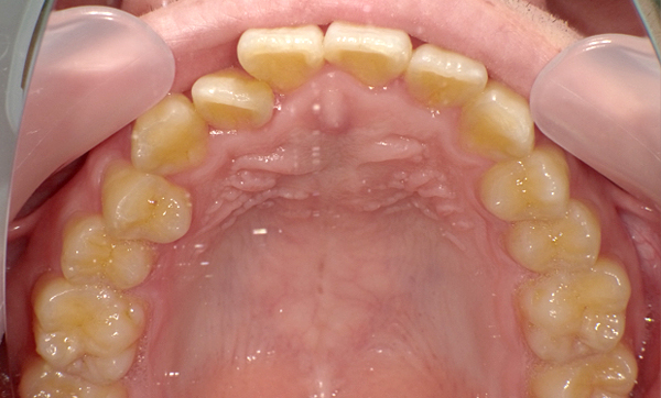 部分矯正 上下の部分矯正の症例写真